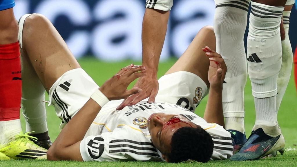 Mbappé, con sangre en la cara.