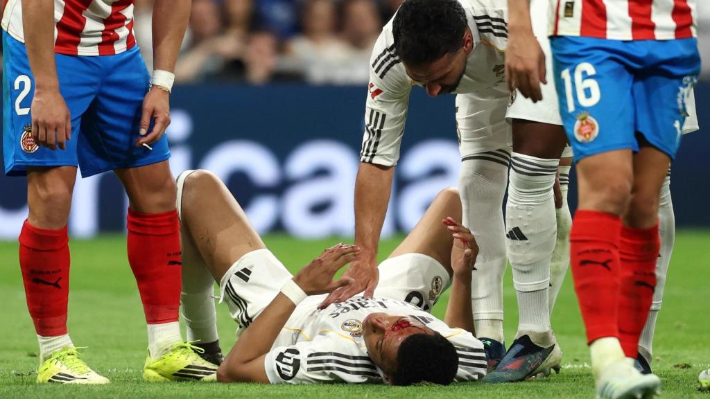 Mbappé, tirado en el césped con la cara ensangrentada.