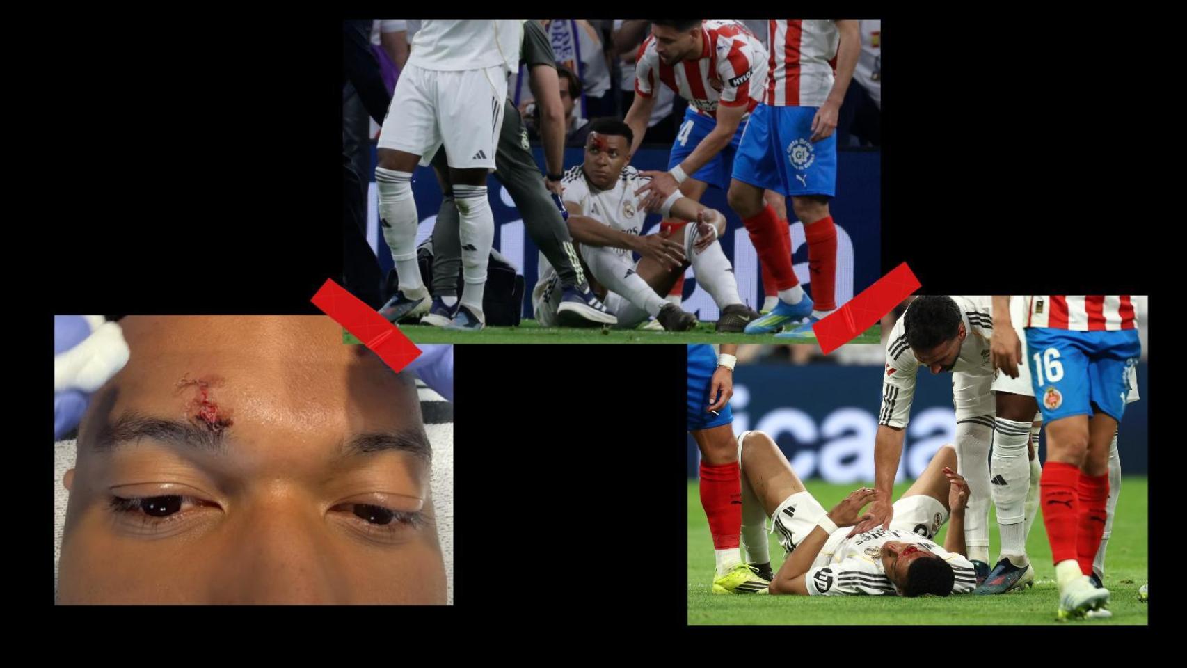 Collage fotos Mbappé con las heridas.
