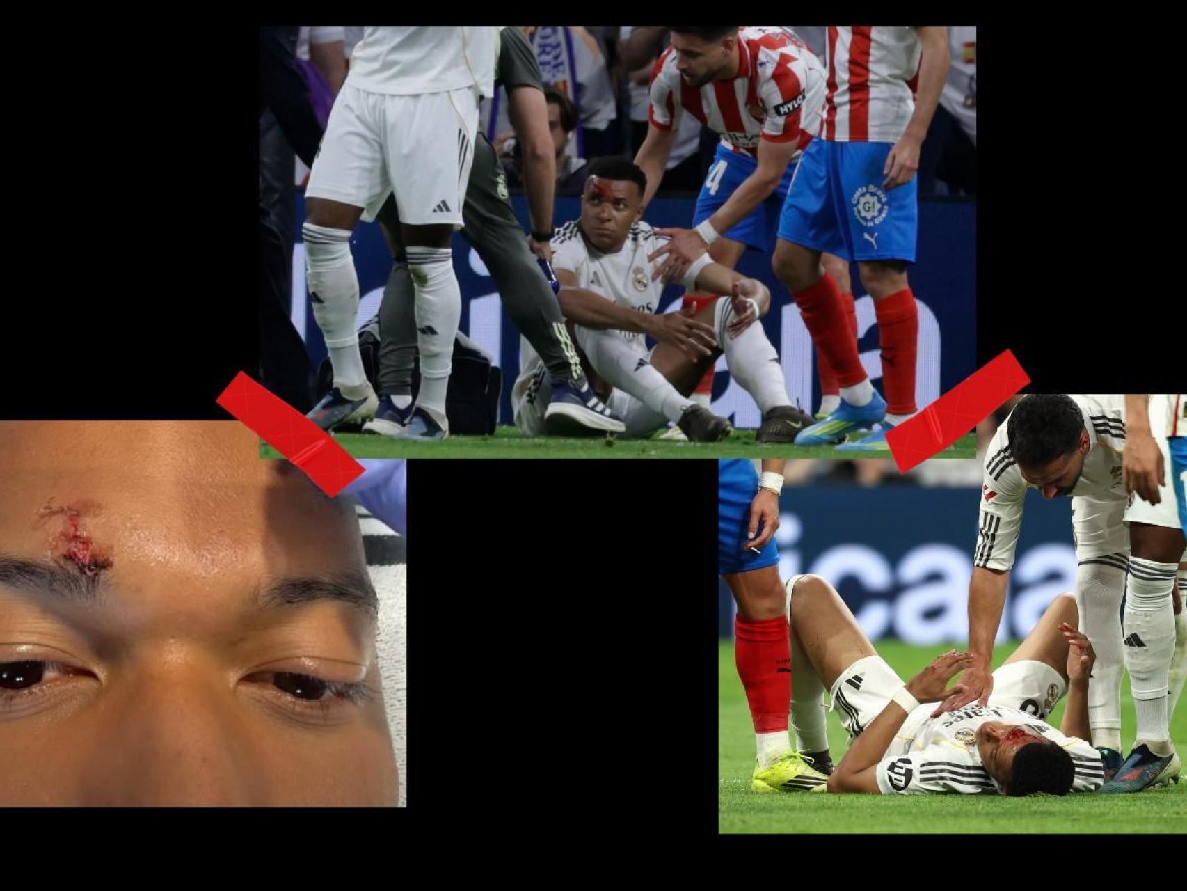 Collage fotos Mbappé con las heridas.