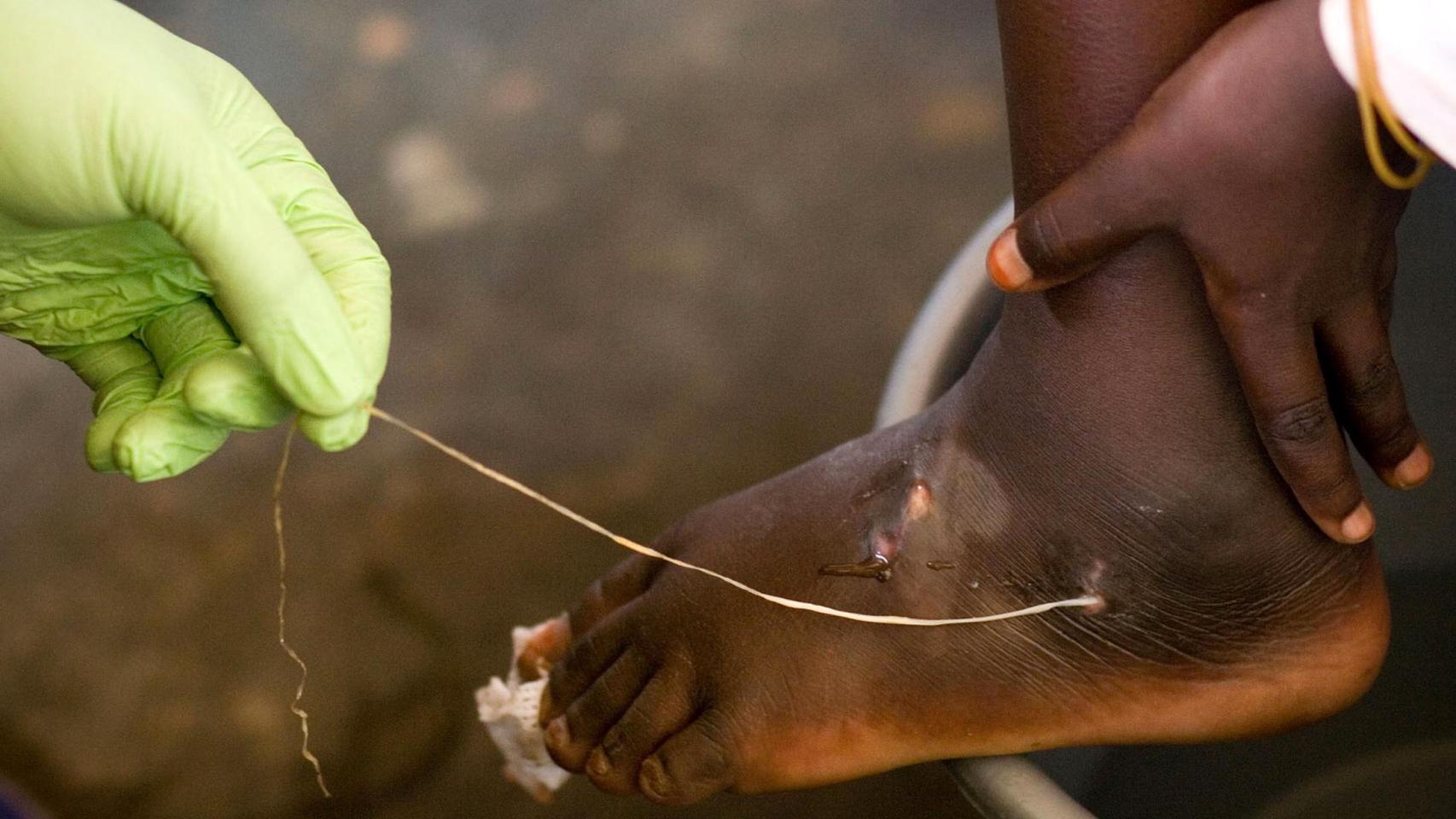 Un sanitario extrae una hembra de gusano de Guinea del pie de un niño.