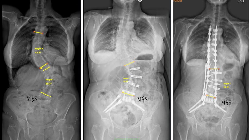 Radiografía escoliosis