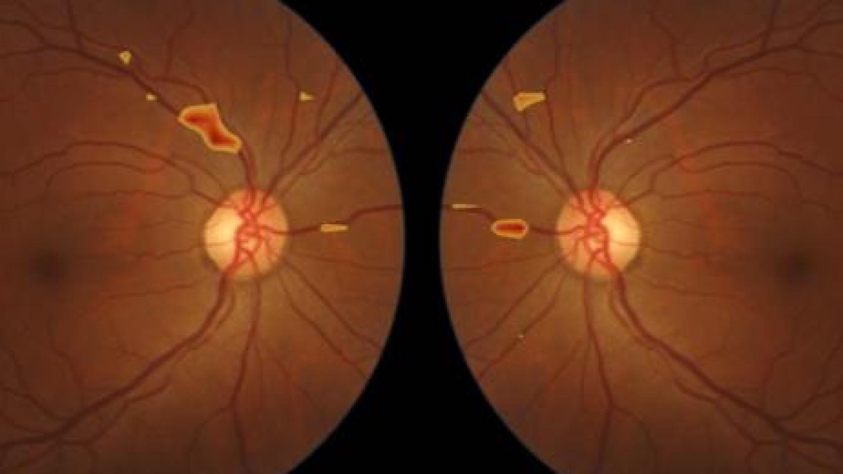 Aitheroscope permite la detección precoz de la aterosclerosis en atención primaria mediante el análisis automatizado de imágenes del fondo del ojo (retinografías).