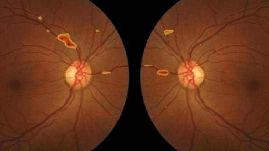 Aitheroscope permite la detección precoz de la aterosclerosis en atención primaria mediante el análisis automatizado de imágenes del fondo del ojo (retinografías).