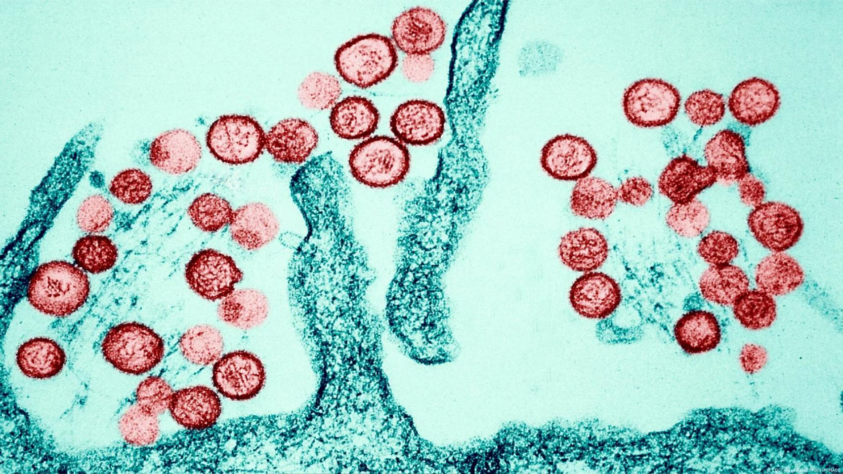 Imagen microscópica de una infección de hantavirus.