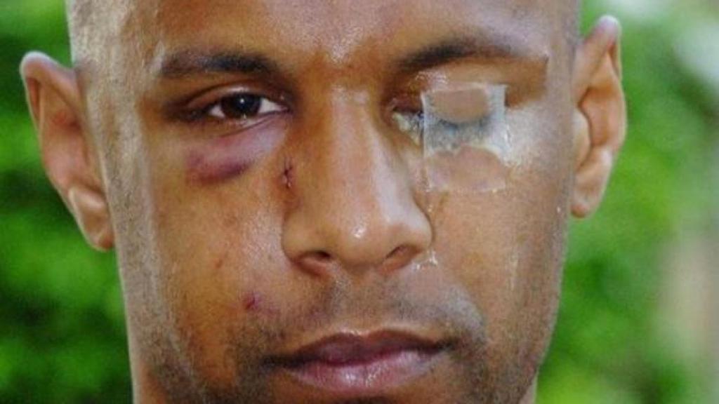 El rostro de Dabo tras la agresión de Barton.