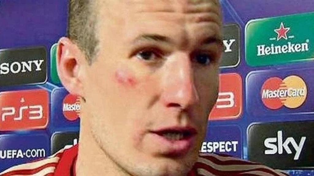 Robben, con una herida en la cara.