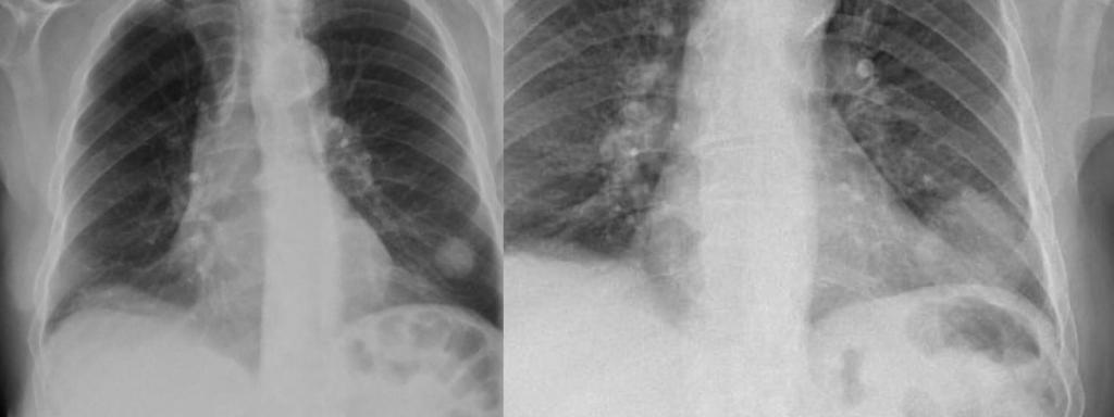 En enero de 2024, la radiografía del tórax detecta un tumor, con forma de pelota, y en pruebas posteriores el cáncer ya estaba en expansión por el pulmón.