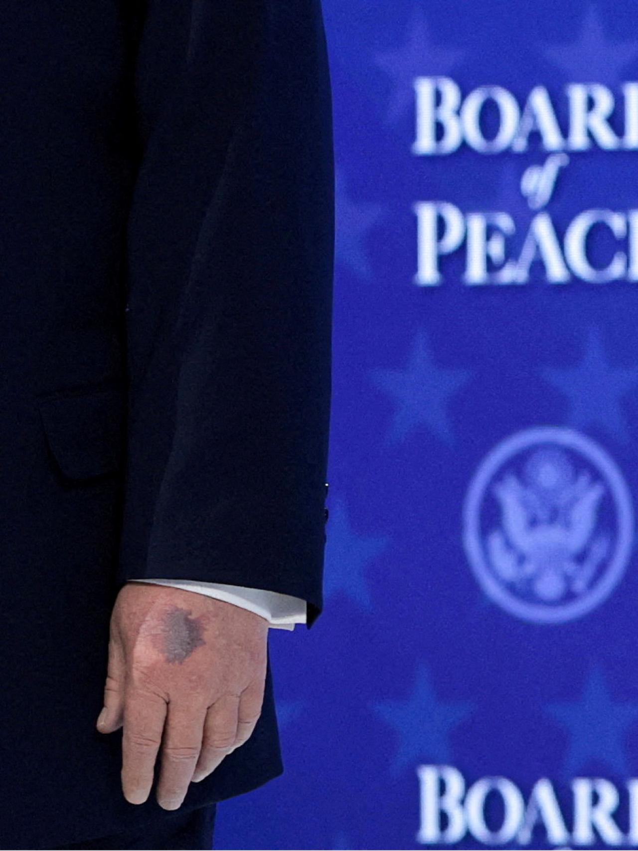 La mano amoratada de Donald Trump.
