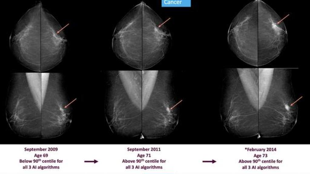 Mamografías de una paciente diagnosticada en 2014 en la que se aprecian señales del cáncer desde cinco años antes.