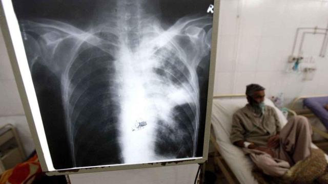 Desde el año 2021 los casos de tuberculosis en España no dejan de crecer.