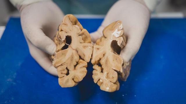 Cerebro de un donante con alzhéimer avanzado.
