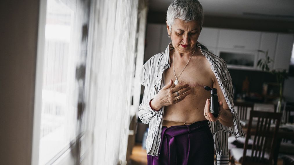 Imagen de archivo de una mujer tras una masectomía.