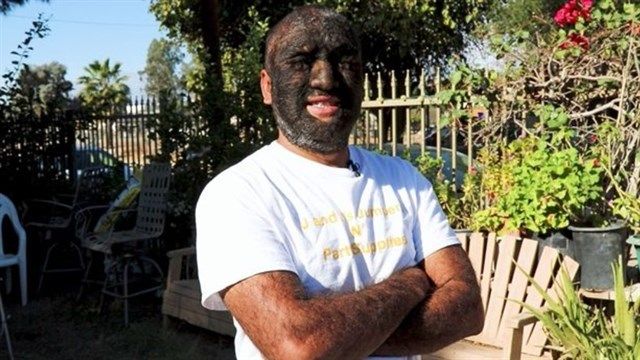 Larry Gómez tiene una enfermedad extraña llamada hipertricosis.