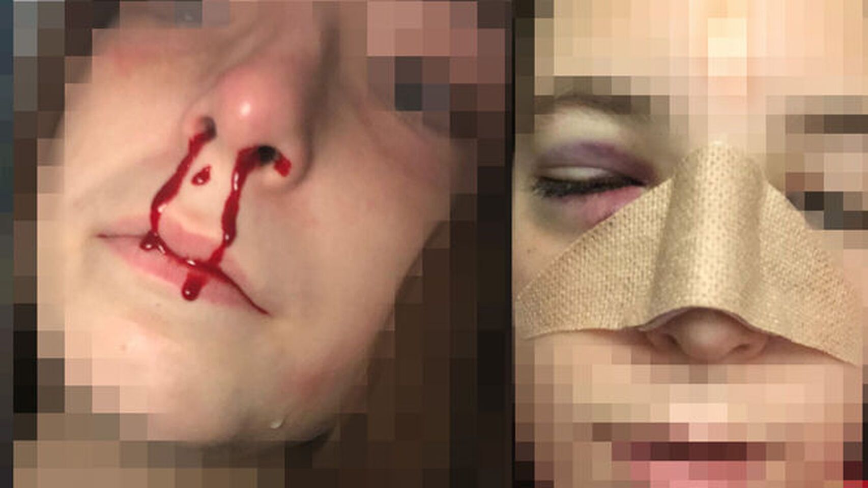 La brutalidad del golpe fue tal que Blanca acabó con el tabique nasal fracturado.